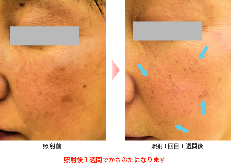photofacial_img_16