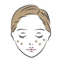 フラクショナルルビーレーザーが有効な治療