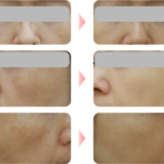 肝斑 フォトフェイシャルM22 施術前後 両頬の色素斑が改善した症例