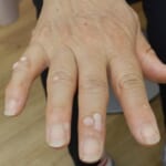 手の指にできたウイルス性いぼ（尋常性疣贅）の写真。表面がザラザラして盛り上がっている
