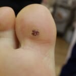 足裏にできた足底疣贅（そくていゆうぜい）の写真。体重で平坦になっているのが特徴