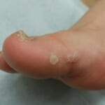 足にできたウイルス性いぼ（尋常性疣贅）の写真