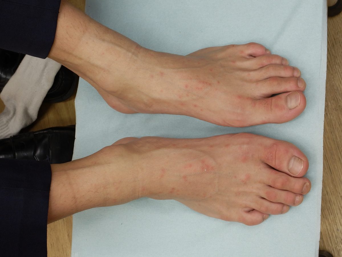 大人の手足口病の症例写真：足の甲と足の指に淡い紅色の小さな発疹が散在している