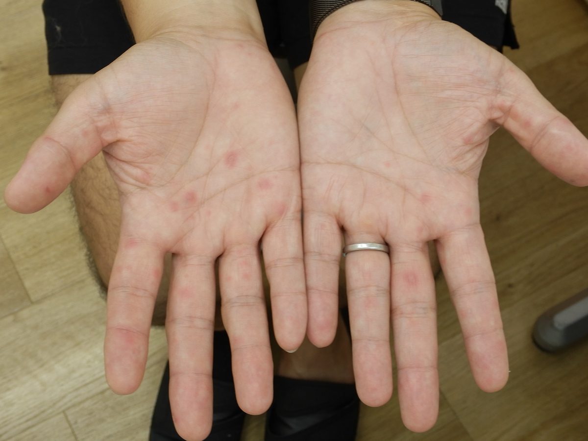 大人の手足口病の症例写真：手のひらに淡い赤色の斑と小さな丘疹がまばらに見られる