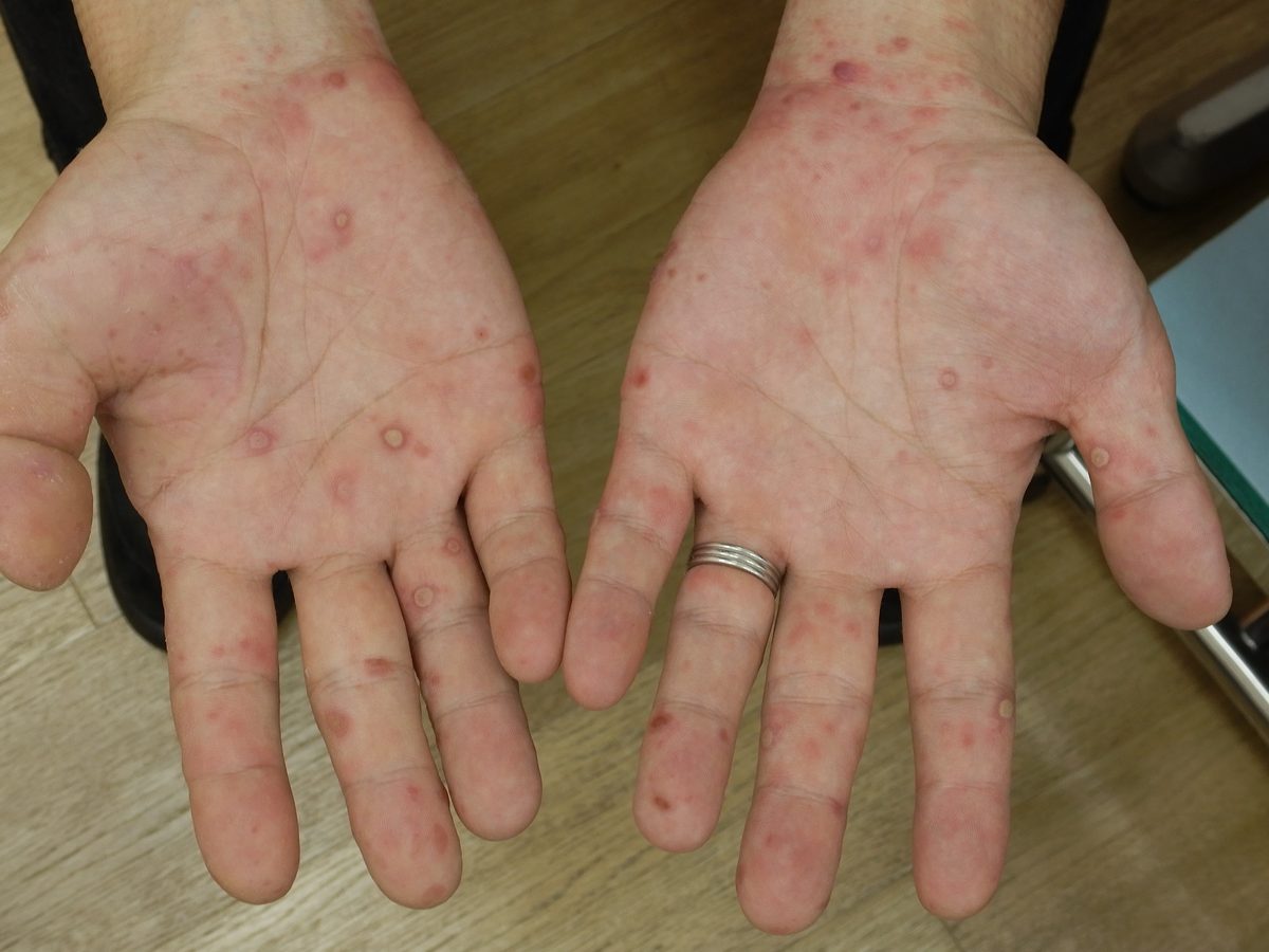 大人の手足口病の症例写真：手のひらから手首にかけて紅斑と小水疱が多数みられる強く出た例