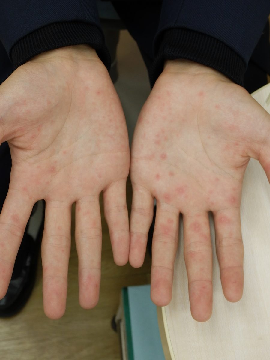 大人の手足口病の症例写真：手のひらと指腹に中心が白く抜ける小水疱を伴う紅色丘疹が多数みられる