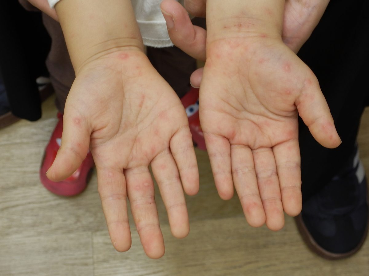 子どもの手足口病の症例写真：両方の手のひらに赤い小さな発疹が散在している
