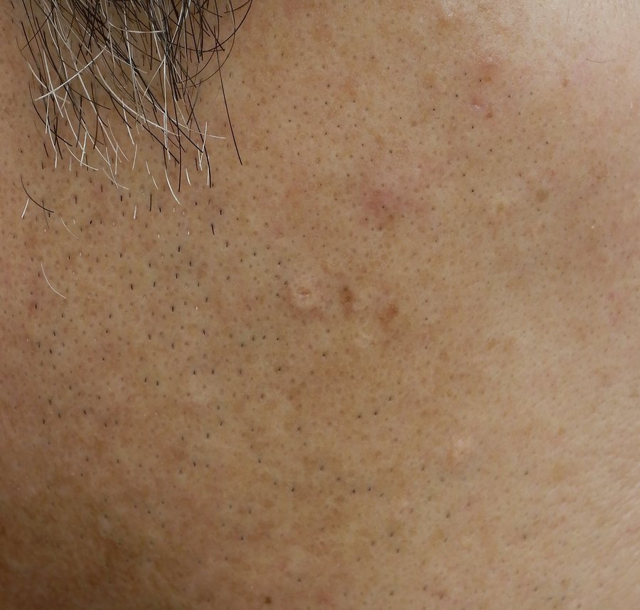 頬にできた小型で多発した脂腺増殖症の症例写真
