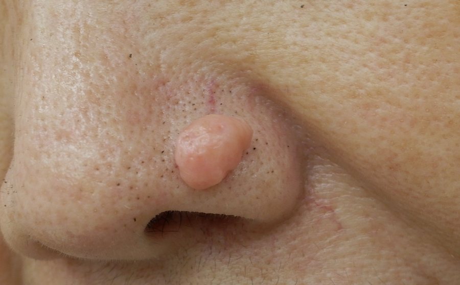 鼻翼にできた大型で分葉状に隆起した脂腺増殖症の症例写真