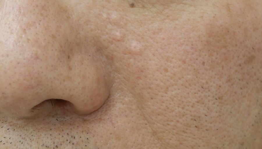 脂腺増殖症の症例写真。鼻翼から頬にかけて多発した黄白色の丘疹