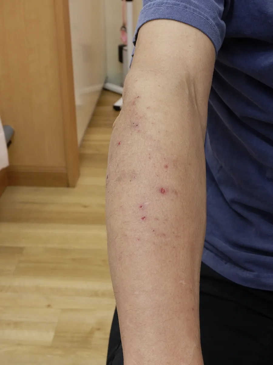 自家感作性皮膚炎の症例写真：前腕にできた散布疹と掻破の跡