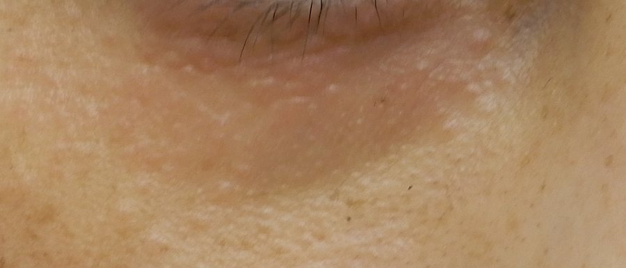 汗管腫の症例写真。下まぶたに多発した1〜4mmの平らな肌色の盛り上がり