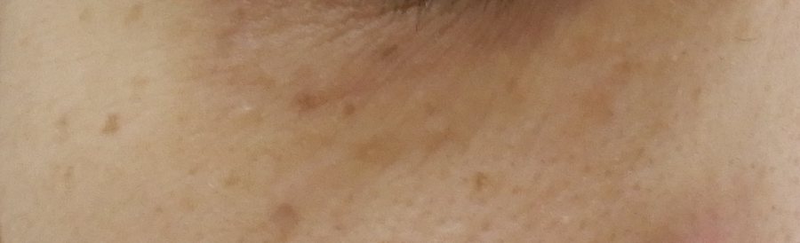 男性の下まぶたにできた汗管腫の症例写真