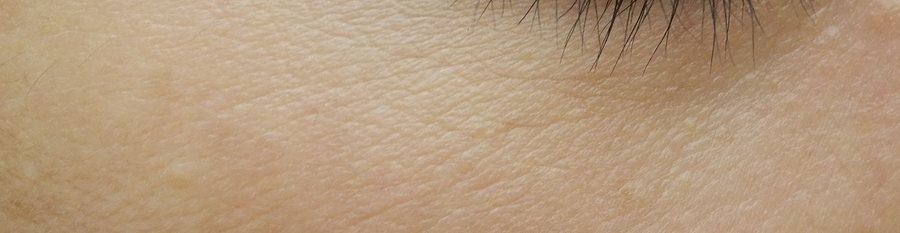 目尻にできた汗管腫の症例写真