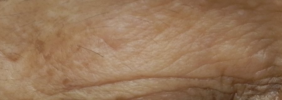 上まぶたに多発した汗管腫の症例写真