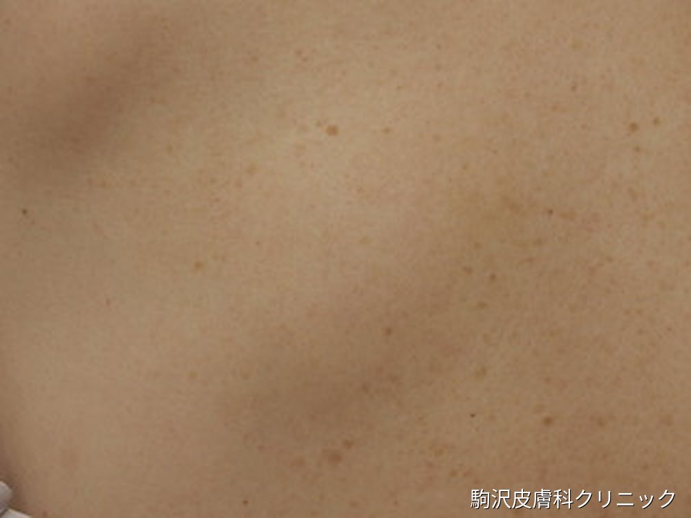 脂肪腫の写真:背中の盛り上がりを近くから撮影。境界はなだらかで皮膚表面は正常