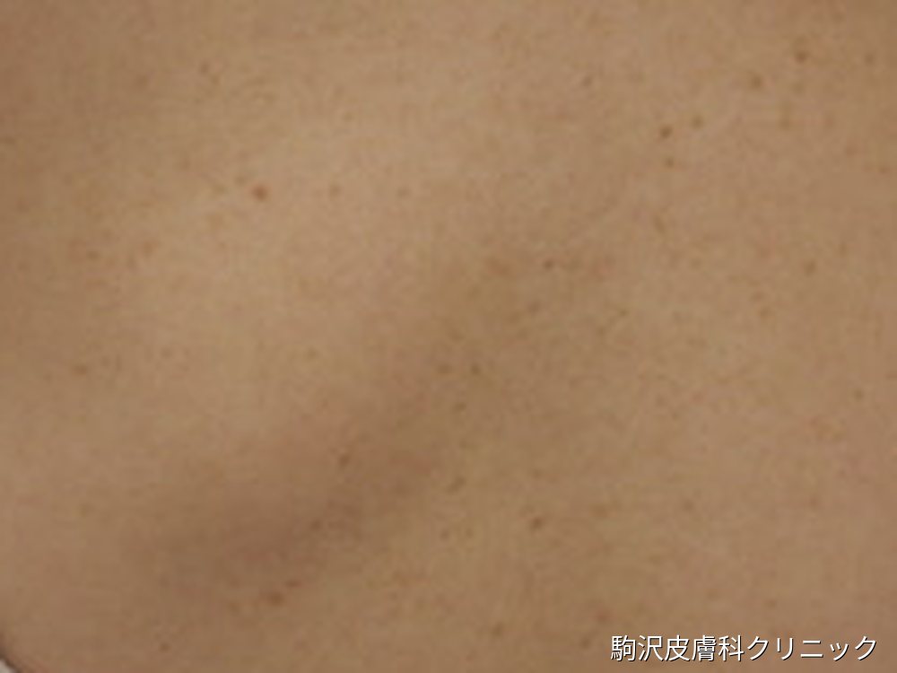 脂肪腫の写真:背中の皮膚の下になだらかな盛り上がりがある。表面に赤みや開口部はない