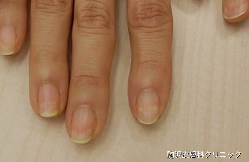 爪甲剥離症の写真：3本の指の爪の先端が黄白色に浮いている