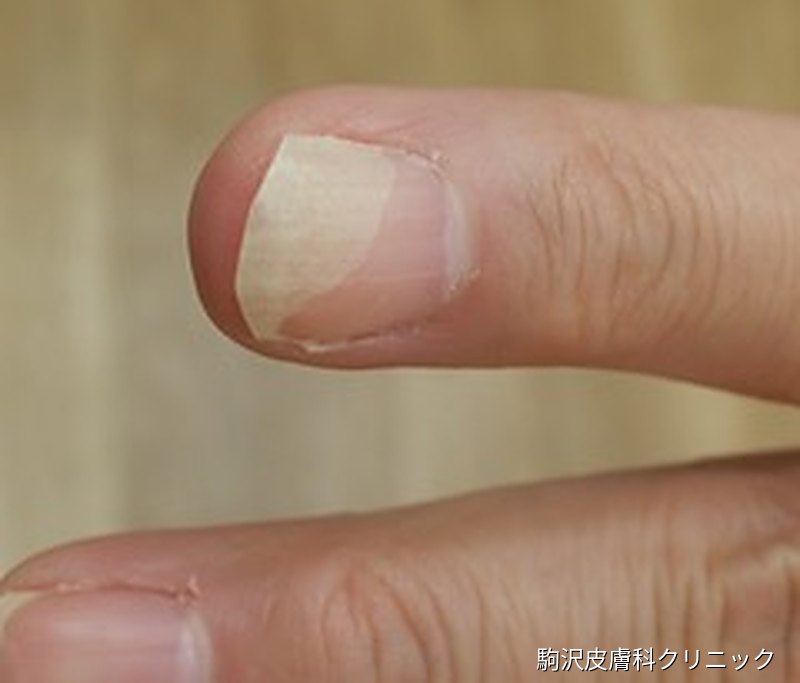 爪甲剥離症の写真：親指の爪が先端から半分近くまで黄白色に浮いている