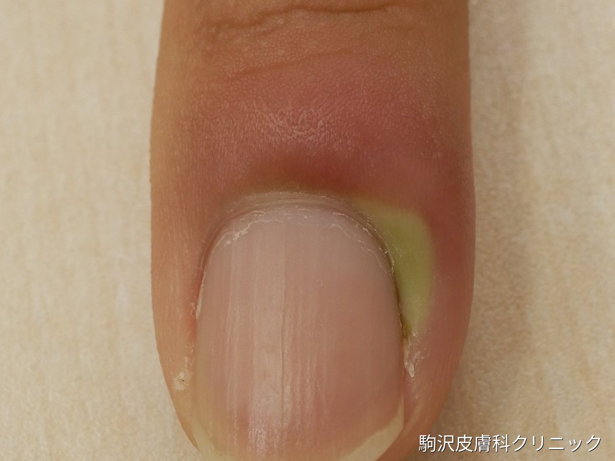 急性爪囲炎の写真（拡大）：爪の横の皮膚の下に黄緑色の膿がたまり、周囲が赤く腫れている