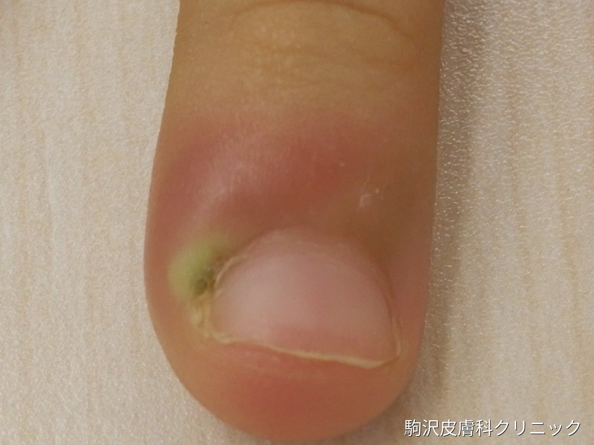 急性爪囲炎（ひょう疽）の写真：指の爪の根元が赤く腫れ、爪のきわに黄緑色の膿が透けて見える