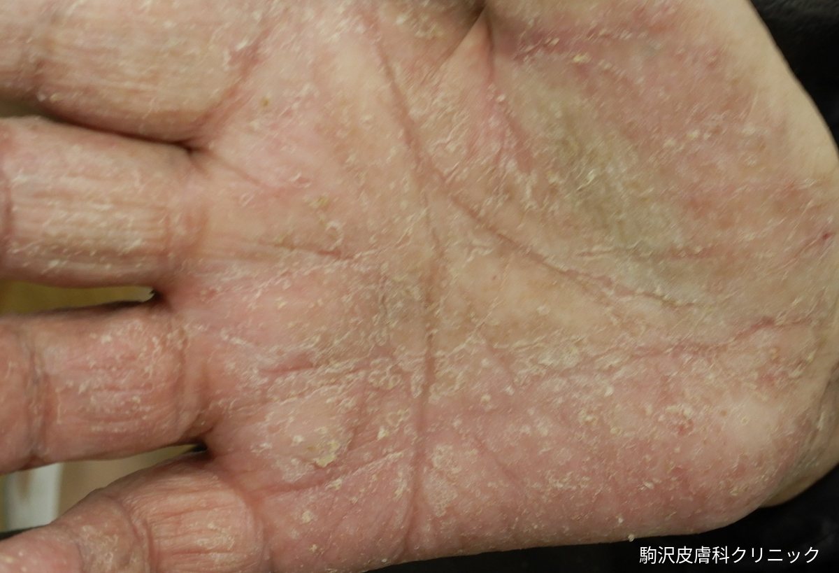 疥癬の写真：手のひら全体に細かい皮むけと赤みが広がっている
